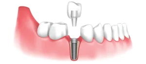 A Beginner’s Guide to The Dental Implant Process